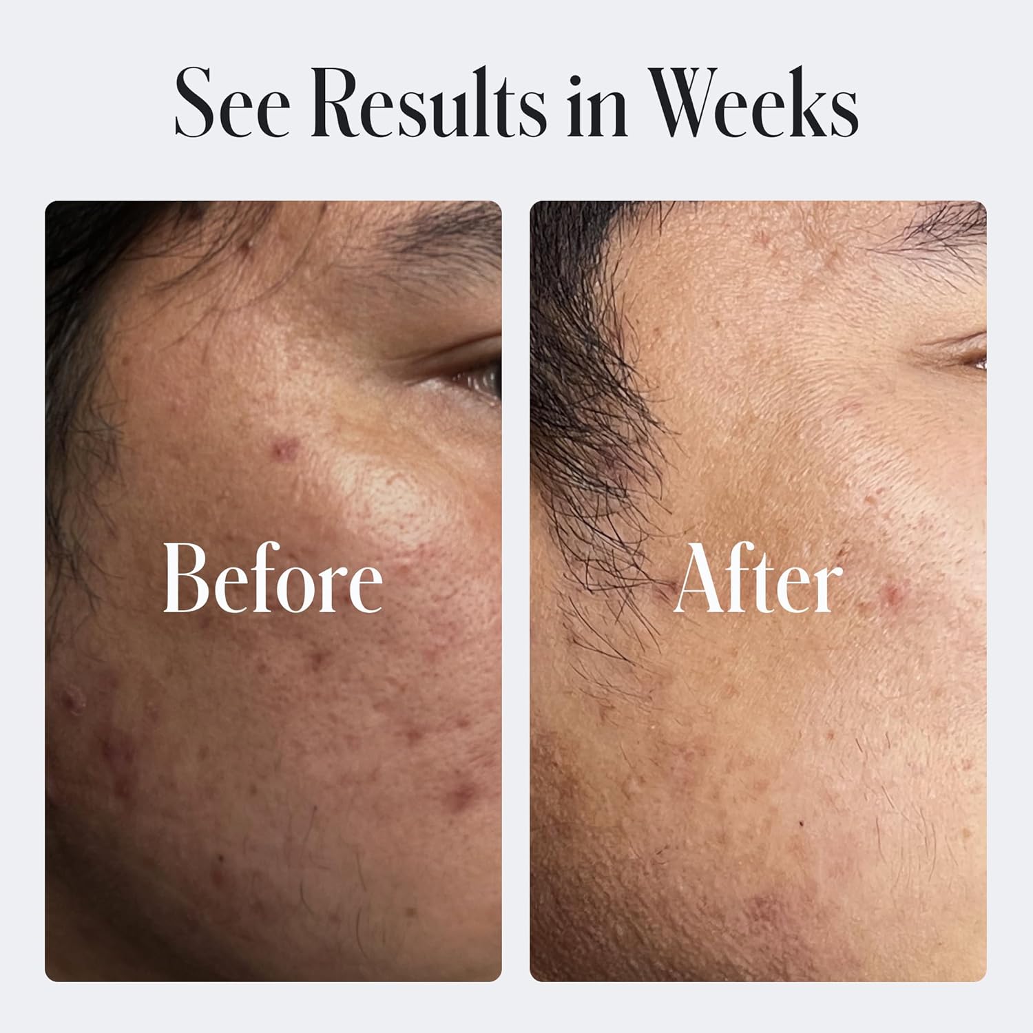 Geologie Clear Skin Face Cream | Clear System Daily Moisturizer with SPF15 for Acne-Prone Skin | Azelaic Acid, Niacinamide & Hyaluronic Acid | Lightweight & Oil Free | 60 ML - Image 6